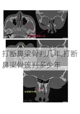 打断鼻梁骨判几年,打断鼻梁骨该判多少年